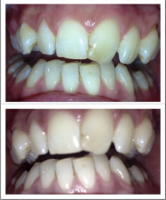 Top is before, bottom after